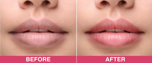Dark, Pigmented Lips? Do You Know Why? Try Natural Lip Balms