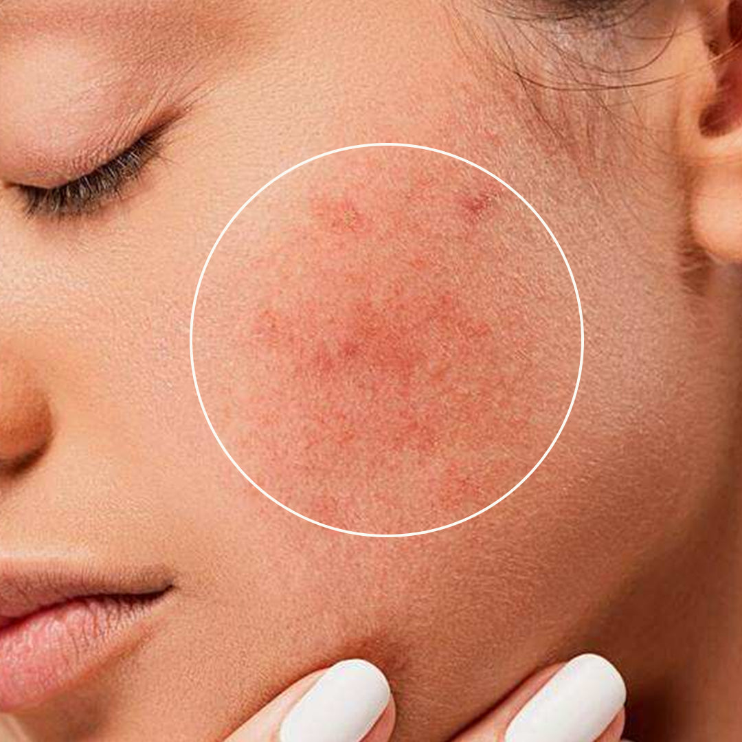 A Guide to Causes and the Best Products for Acne-Prone Skin