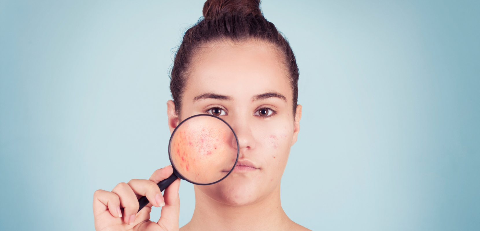 How to Take Care of Acne-Prone Skin in Summers