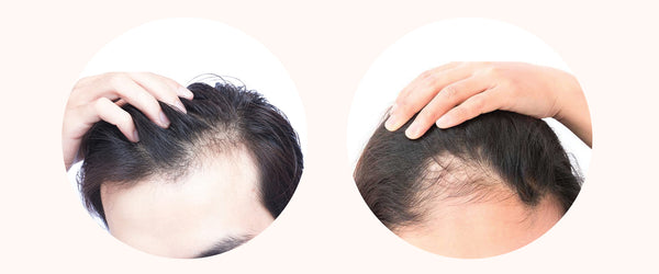 The truth about hair thinning – is there a cure?