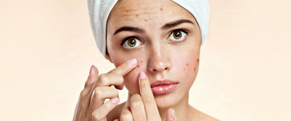No More Pimple Marks: Know How to Remove Pimple Scars & Marks Naturally at Home?