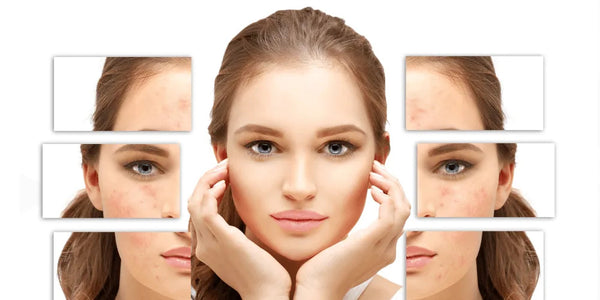 acne treatments