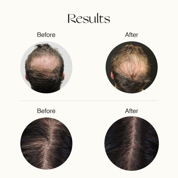 Advanced Hair Growth Serum (2 Months Pack)